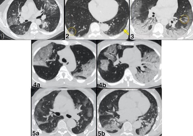 Hình ảnh CT cho thấy tổn thương phổi lan tỏa do sốc nhiễm khuẩn tụ cầu vàng.