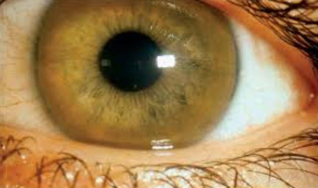 Vòng Kayser–Fleischer trên giác mạc là dấu hiệu đặc trưng giúp chẩn đoán Wilson.