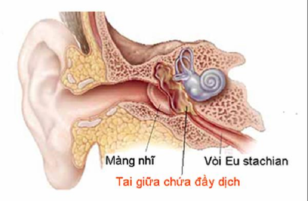 Khi bị viêm tai ứ dịch trẻ sẽ có cảm giác nặng tai vì dịch tụ bên trong