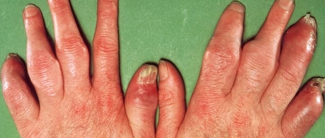 Ngón tay sưng nề, đỏ như hình