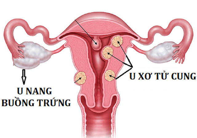 Khối u nang buồng trứng có thể là nguyên nhân gây dậy thì sớm ở trẻ em.