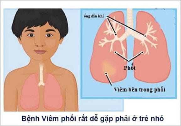 Môi trường sống mất vệ sinh cũng là nguy cơ khiến trẻ dễ mắc bệnh viêm phổi.