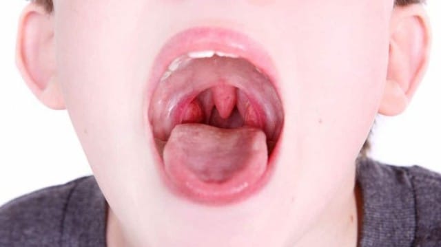 Viêm họng cấp thường do virus, vi khuẩn gây ra.