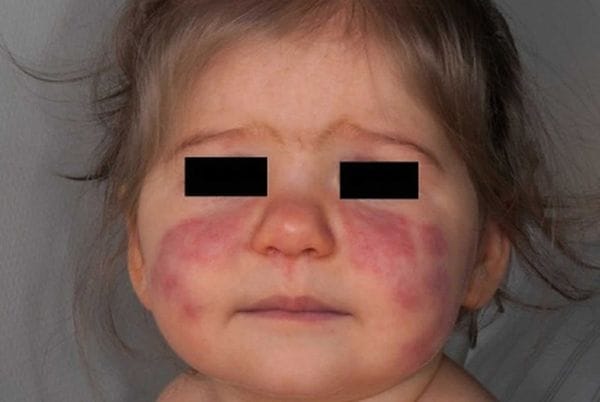 Người bệnh Lupus rất nhạy cảm với ánh sáng.