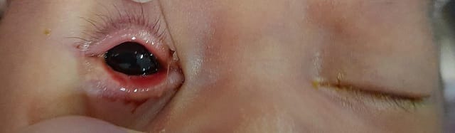 Tổn thương mắt ở bé sơ sinh 14 ngày tuổi được điều trị tại Bệnh viện Sản Nhi Vĩnh Phúc.
