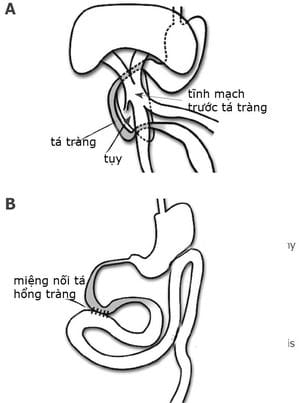 Để phát hiện sớm dị tật tắc tá tràng bẩm sinh, các mẹ bầu cần khám thai thường xuyên