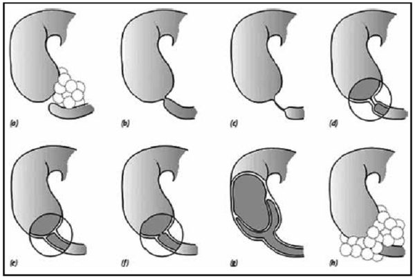 Tắc tá tràng bẩm sinh là sự bít tắc hoàn toàn hoặc một phần tá tràng