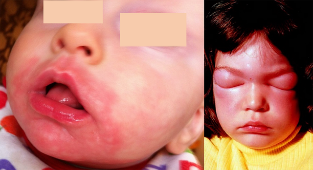 Triệu chứng có thể gặp trong dị ứng đạm sữa bò là ngứa miệng, mày đay, sưng phù mặt