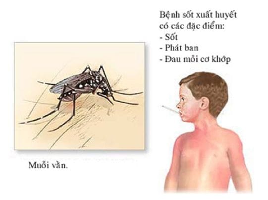 Sốt xuất huyết là bệnh truyền nhiễm cấp tính dovirus Denguegây ra
