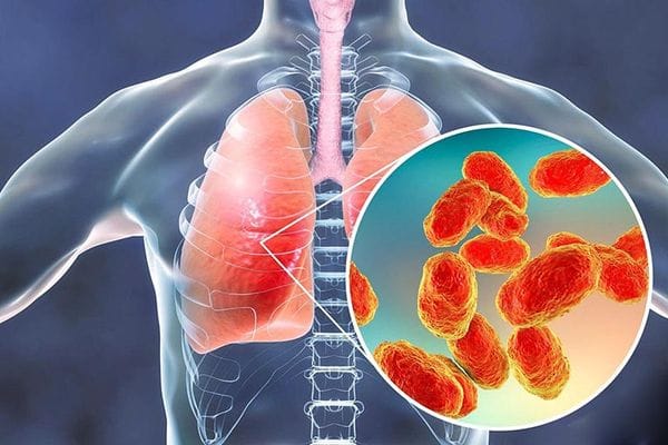 Viêm tiểu phế quản là bệnh viêm nhiễm cấp tính