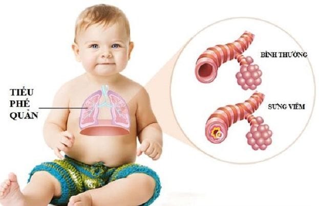 Bệnh viêm tiểu phế quản rất phổ biến ở trẻ dưới 2 tuổi.