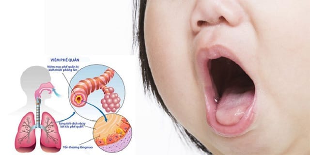 Việc chăm sóc đúng cách khi trẻ bị viêm tiểu phế quản sẽ góp phần giúp trẻ tránh được bệnh