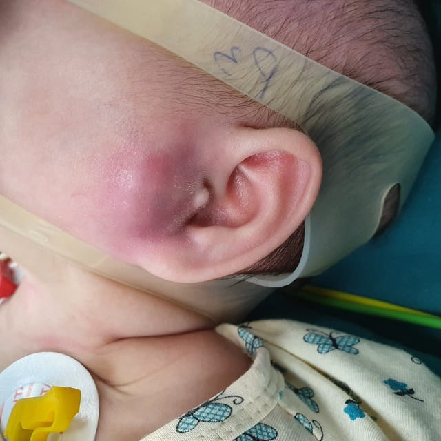 Nhọt ống tai ở trẻ nhỏ.