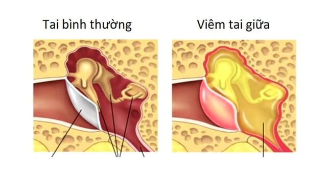 Viêm tai giữa là hiện tượng niêm mạc tai giữa bị xung huyết và hóa mủ.