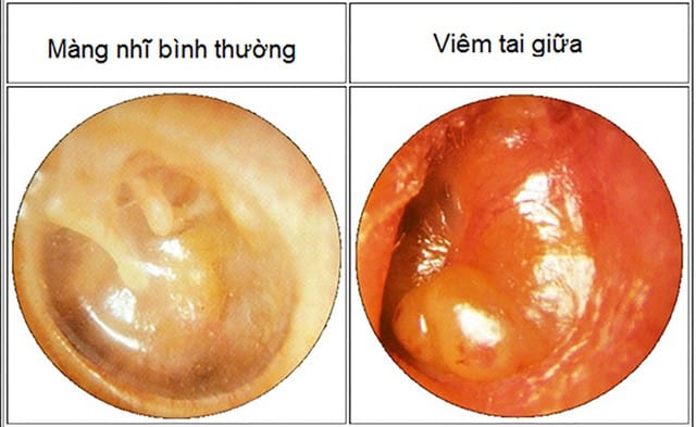Hình ảnh màng nhĩ bình thường và tai giữa bị viêm