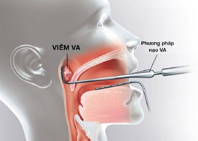 Nạo V.A sẽ nguy hiểm nếu người bệnh bị dị ứng hoặc sốc phản vệ do thuốc mê.