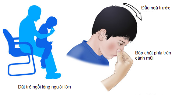 Khi trẻ bị chảy máu cam, hướng dẫn trẻ bóp chặt phía trên cánh mũi và giữ chặt trong khoảng 10 phút.