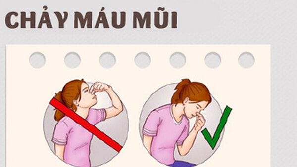 Vách ngăn mũi bị vẹo là một trong những nguyên nhân gây chảy máu cam ở trẻ.