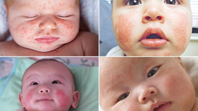 Có nhiều nguyên nhân gây bệnh chàm sữa, trong đó yếu tố di truyền chiếm 60%.