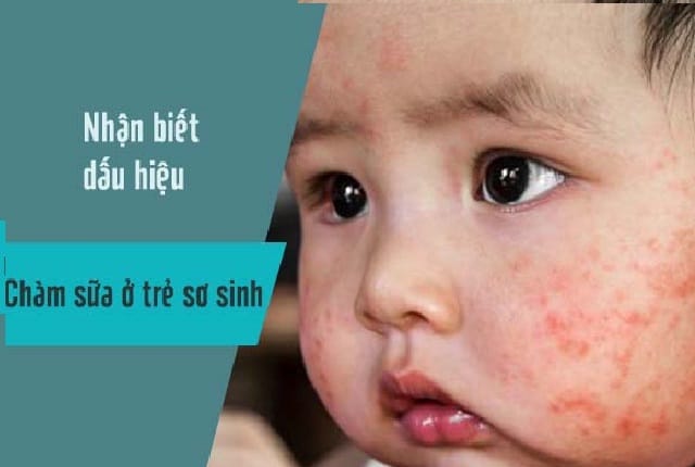 Chàm sữa là dạng chàm thể tạng ở trẻ từ 2 tháng - 2 tuổi.