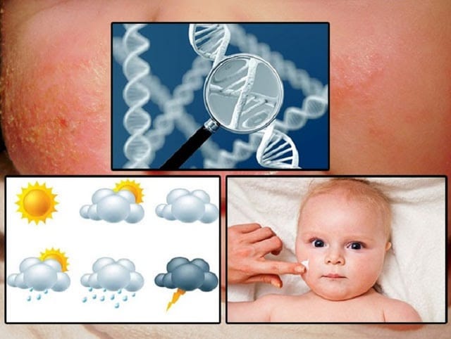 Ở trẻ em bệnh chàm sữa hiếm khi liên quan đến dị ứng thực phẩm.