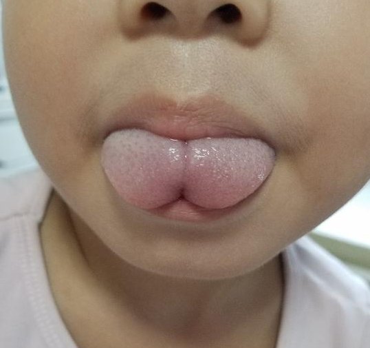 Đầu lưỡi trẻ có hình trái tim do cử động của lưỡi bị giới hạn.