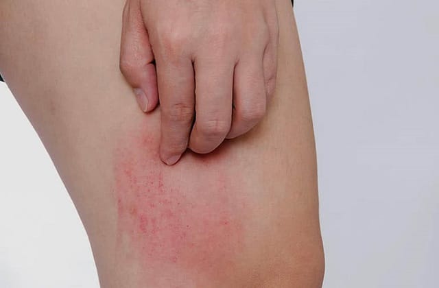 Viêm khớp vảy nến là một bệnh lý kết hợp thương tổn vẩy nến ở da.