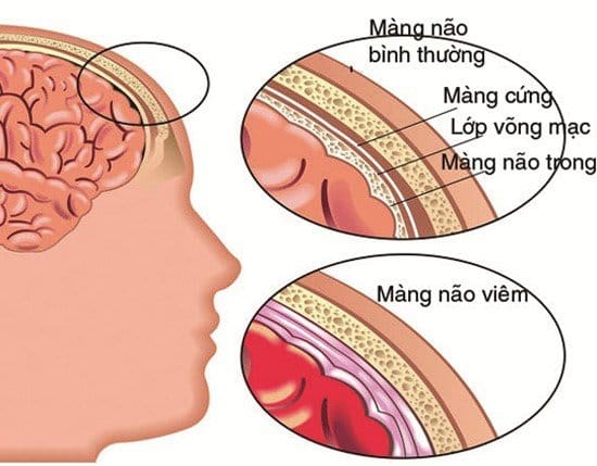 Hình ảnh màng não bị viêm