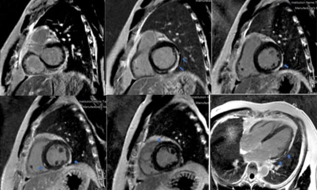 Hình ảnh MRI tim cho thấy vùng cơ tim bị viêm và tổn thương do phản ứng miễn dịch.