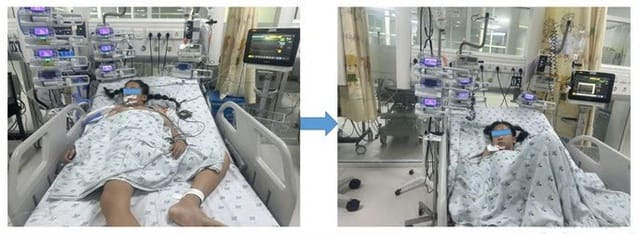 Bệnh nhi 11 tuổi bị viêm cơ tim tối cấp, sốc tim, viêm phổi và phù phổi. Ảnh: BVCC.