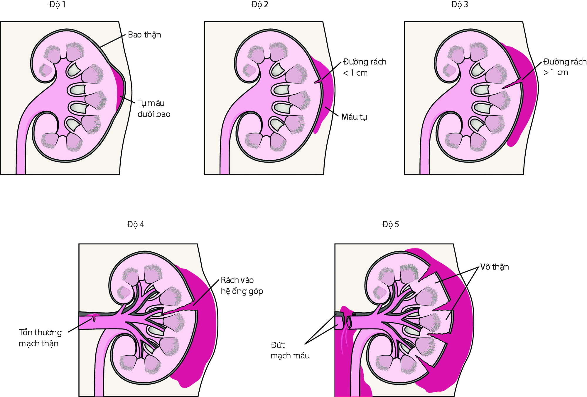 Mức độ phân loại chấn thương thận.