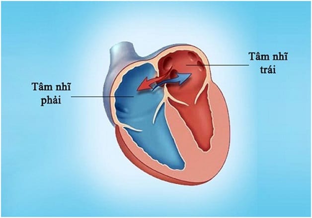 Khiếm khuyết ở vách ngăn tâm nhĩ.