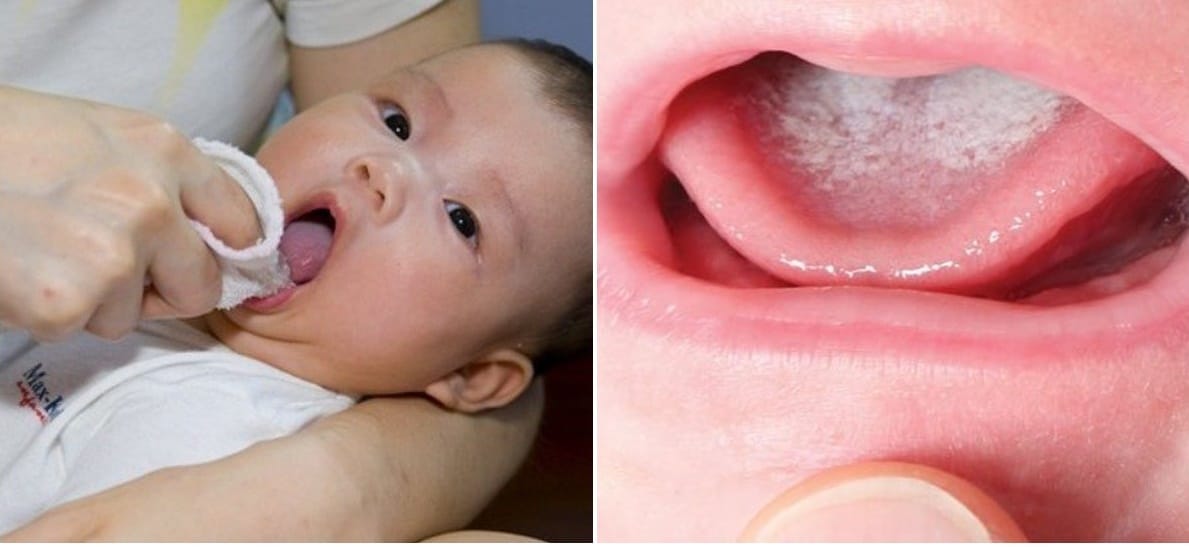 Việc vệ sinh đúng cách khi bé bị tưa miệnglà vô cùng quan trọng.