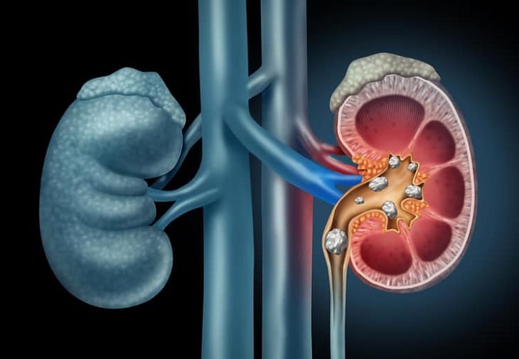 Viêm cầu thận cấp ở trẻ em là một bệnh lý khá phổ biến.