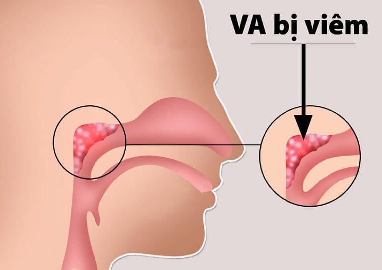 Hình ảnh viêm VA ở trẻ.