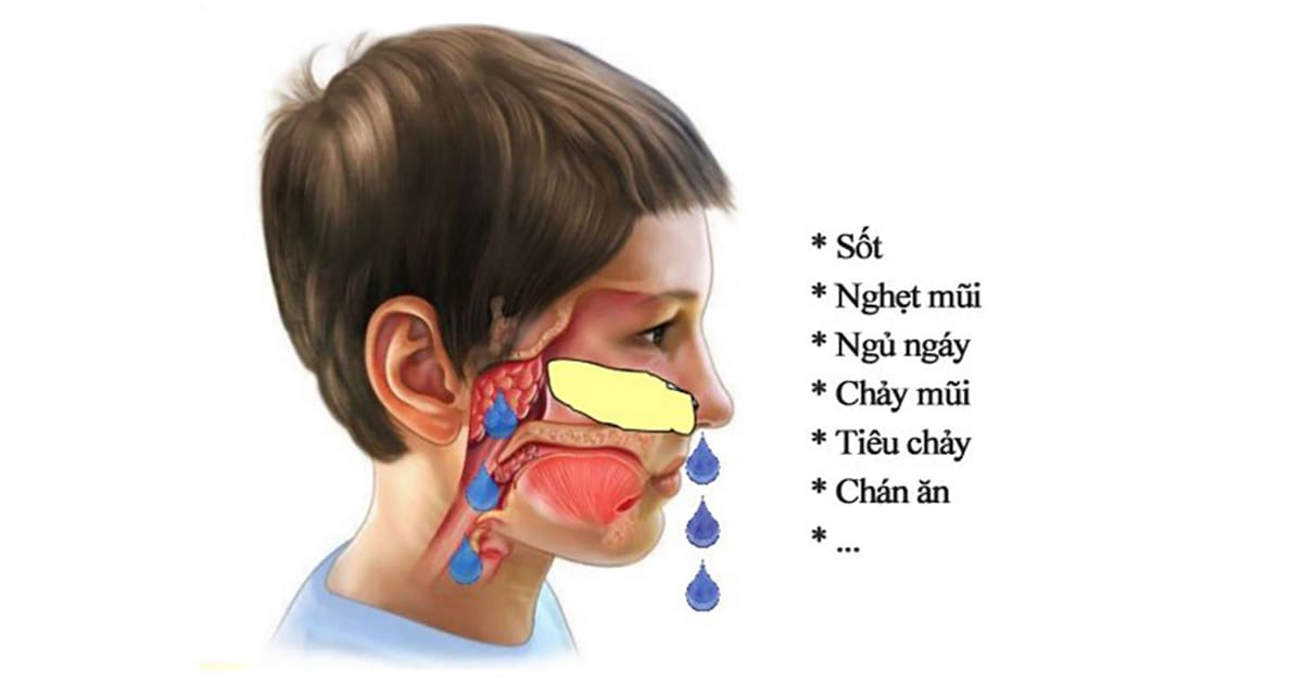 Các biểu hiện viêm VA.