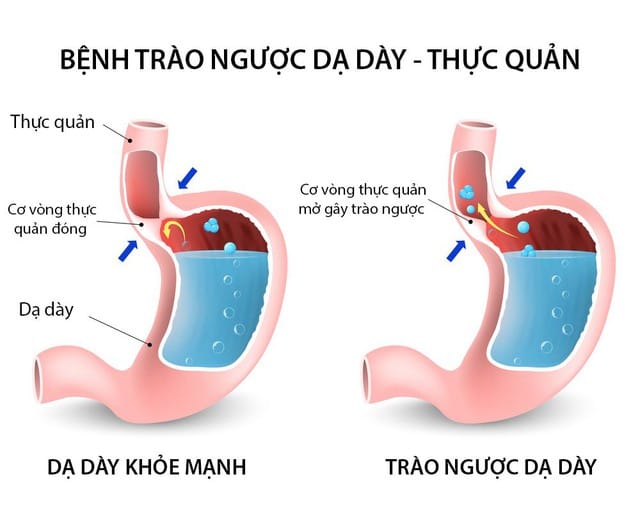 Trào ngược dạ dày thực quản là một tình trạng rối loạn tiêu hóa kéo dài.
