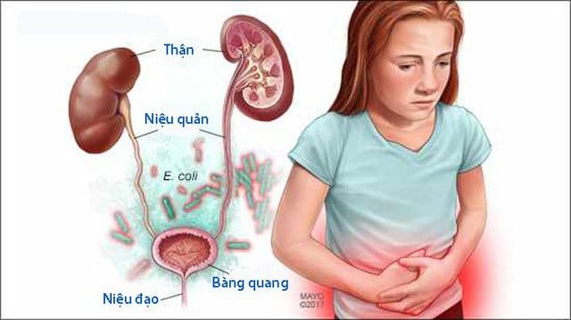 Có nhiều nguyên nhân dẫn đến trẻ bị nhiễm trùng đường tiểu.