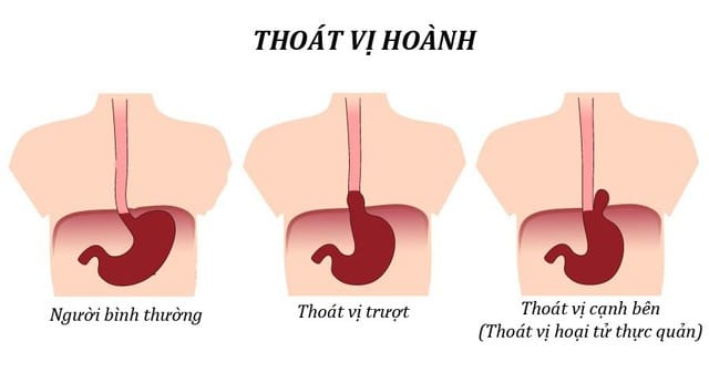Thoát vị cơ hoành thường liên quan về bất thường về nhiễm sắc thể.