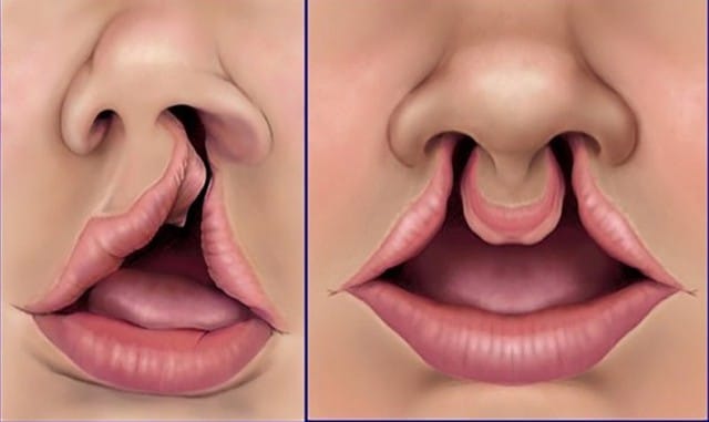 Khe hở môi - vòm miệng là dị tật bẩm sinh thường gặp.