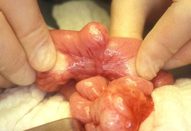 Viêm túi thừa Meckel ở trẻ em thường diễn tiến âm thầm, vì vậy việc phát hiện sớm là vô cùng quan trọng.