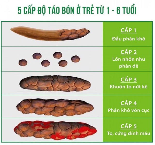 5 cấp độ táo bón ở trẻ từ 1 - 6 tuổi.