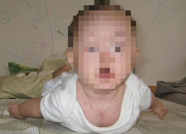 Chẩn đoán sớm và điều trị đúng giúp trẻ mắc nhược cơ bẩm sinh cải thiện vận động, giảm nguy cơ khủng hoảng hô hấp.