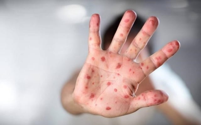 Bệnh tay chân miệng do nhiều chủng virus gây nên.