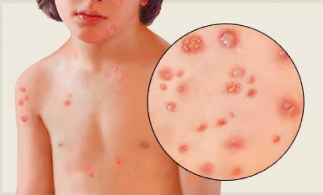 Sau thời gian ủ bệnh từ 10 - 21 ngày, trên cơ thể người bị thuỷ đậu sẽ bắt đầu phát ban dạng mụn nước.