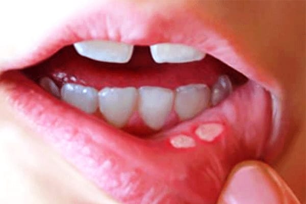 Đối với trẻ nhỏ, nhiệt miệng là một trong những căn bệnh phổ biến và gây khó chịu nhất.