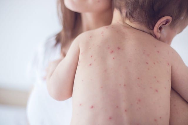 Sốt xuất huyết hiện nay chưa có thuốc điều trị đặc hiệu và chưa có vaccine phòng bệnh.