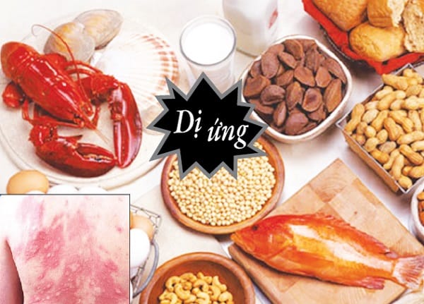 Thủ phạm gây dị ứng thức ăn thường gặp là tôm, cá, sữa bò, trứng, lạc, đậu nành…