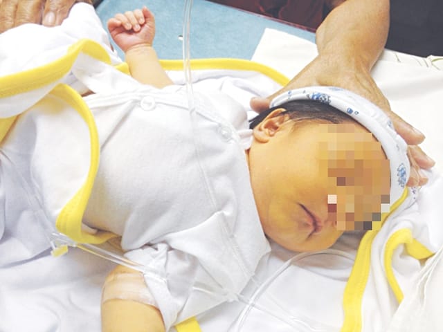 Vàng da ở trẻ sơ sinh có hai loại, đó là vàng da sinh lý và vàng da bệnh lý. Ảnh minh họa