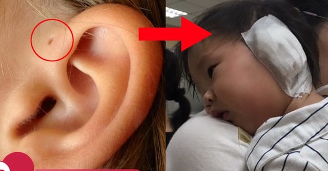 Phẫu thuật rò luân nhĩ hiện nay khá đơn giản, bệnh nhân có thể về nhà ngay trong ngày